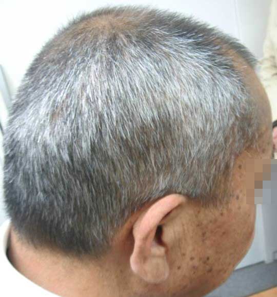 psoriasis_cases_16.JPG
