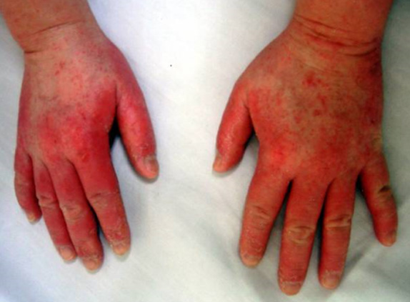 接触性皮膚炎（手の甲）