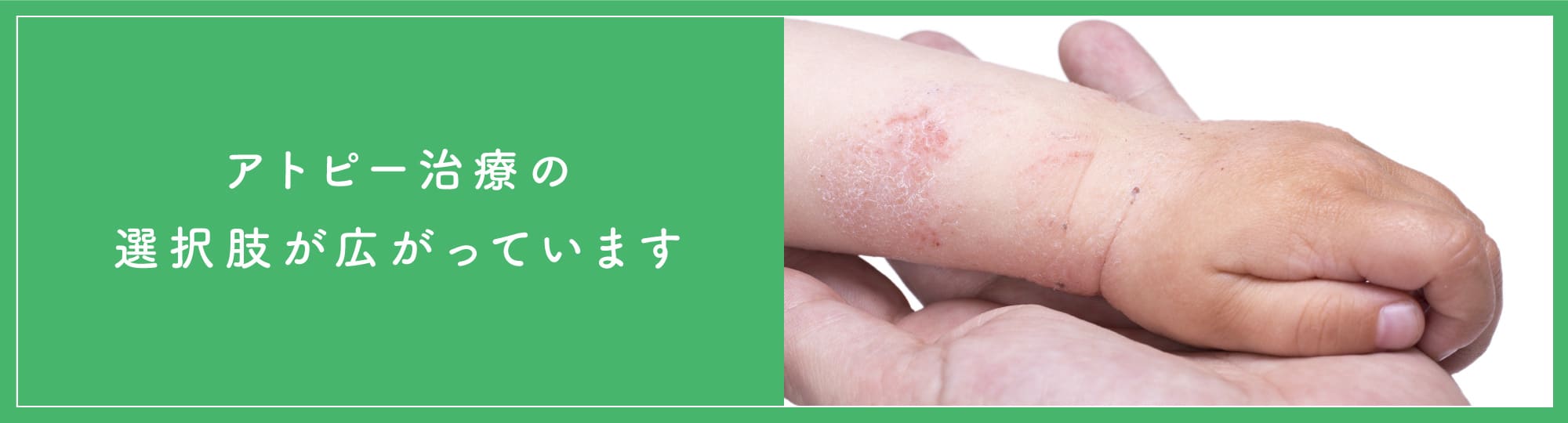 アトピー治療の選択肢が広がっています