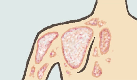 乾癬(かんせん)肩